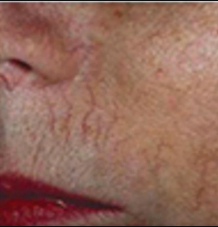 Before - vascular lesions