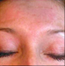 After - pigmentation