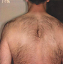 Before - hair removal