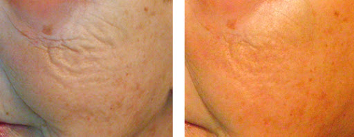 Before and After comparison