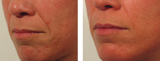 Before and After comparison