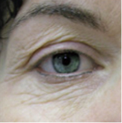 After - eye wrinkles