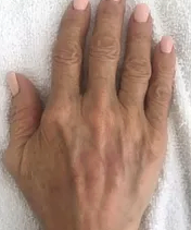After - hand spots
