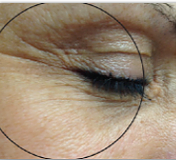 Before - eye wrinkles