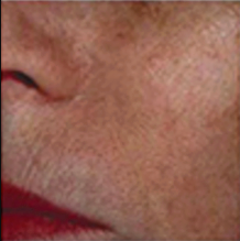 After - vascular lesions