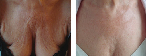 Before and After - chest