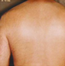 After - hair removal