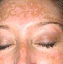 Before - pigmentation